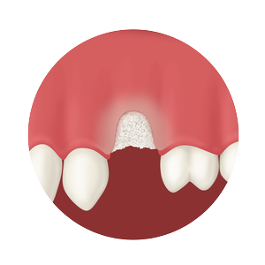 Periodontal Defects