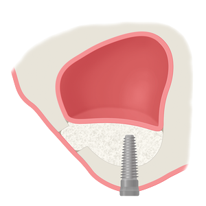 Trans Crest Sinus Aug